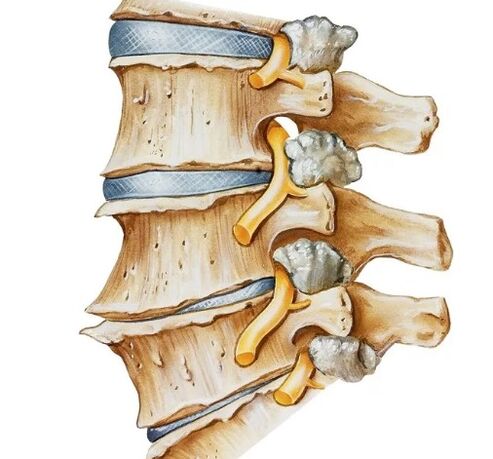 Pinching the nerves in the spine