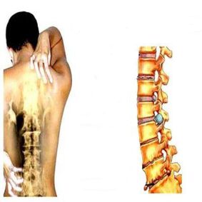 Level of osteochondrosis