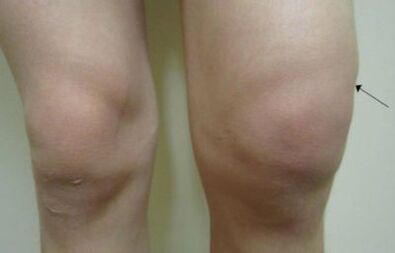 Clinical manifestations of knee joint arthrosis