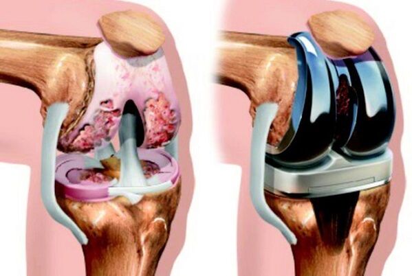Before and after endoprosthetics knee joints with arthrosis