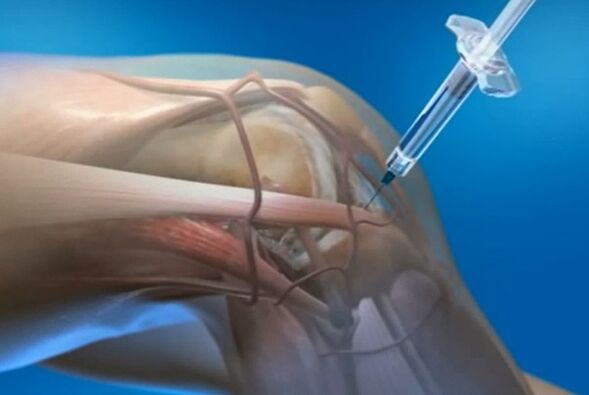 intra -articular injection for knee joint arthrosis
