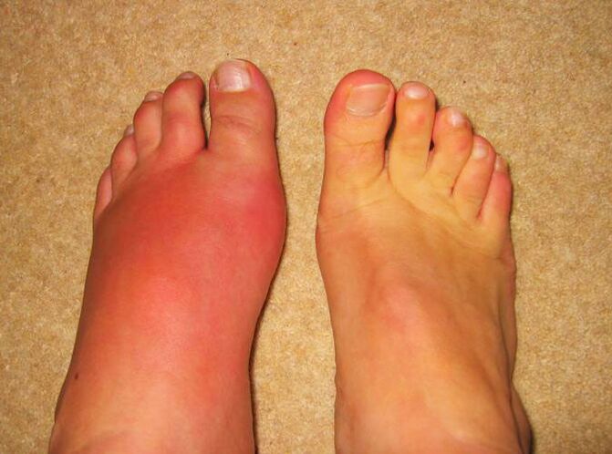 pain in the leg joints due to gout