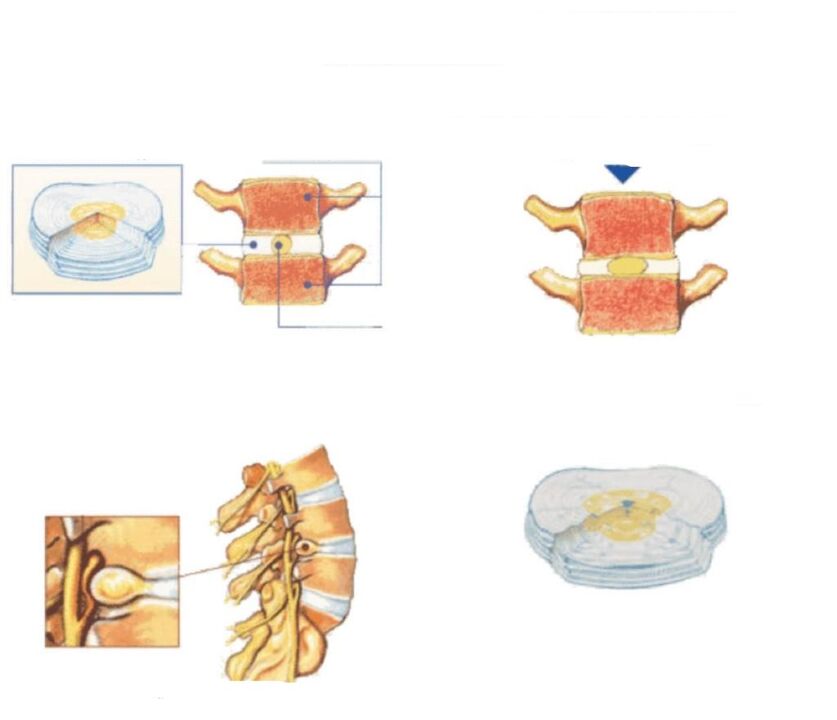 damage to the intervertebral disc